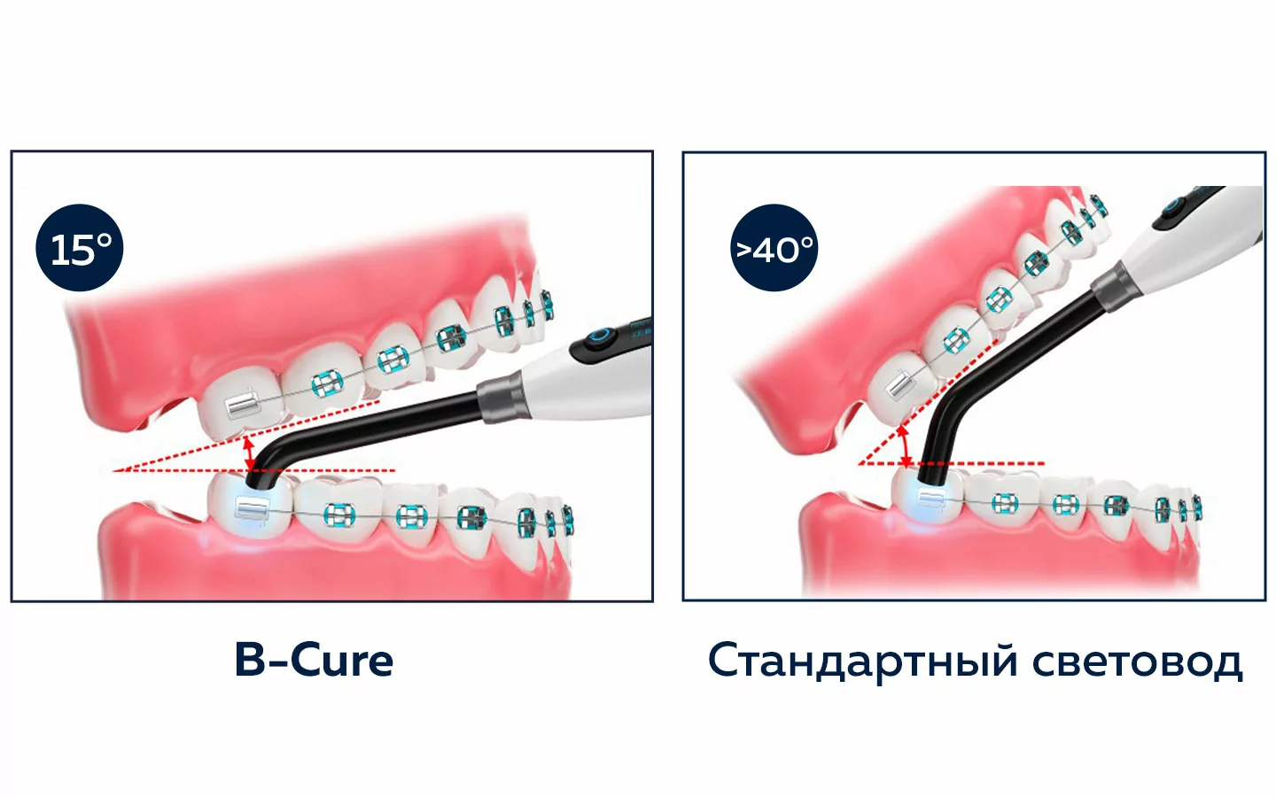 Форма световода B-Cure облегчает доступ к дальним зубам