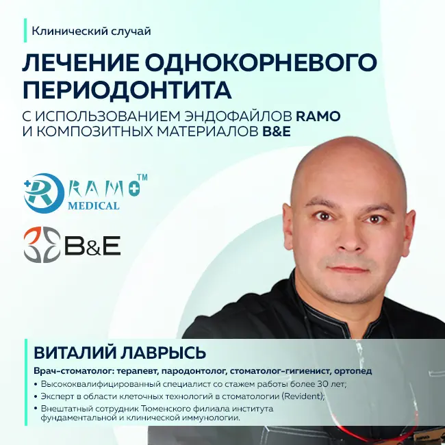 Периодонтит, один корень, один корневой канал 