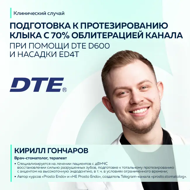 Клинический случай: прохождение облитерированного канала клыка