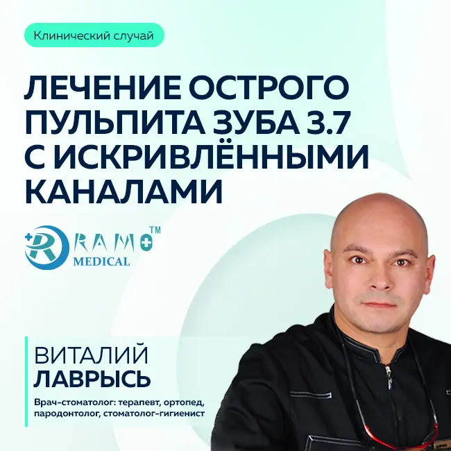 Клинический случай: лечение острого пульпита зуба 3.7 с искривлёнными каналами
