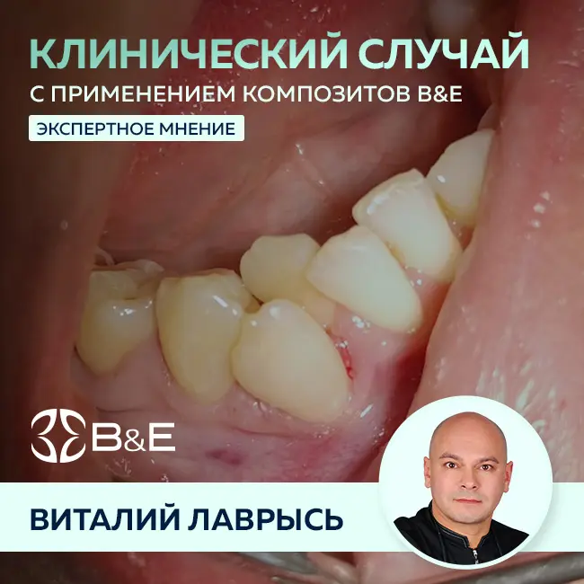 Виталий Лаврысь: “43, 44 зубы, кариес дентина, вестибулярная полость”