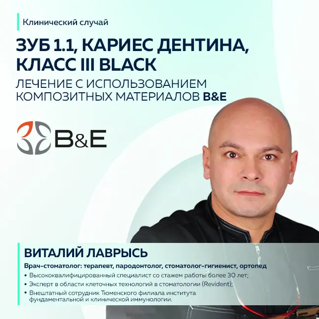 Виталий Лаврысь: "1.1 зуб, кариес дентина, класс III Black"