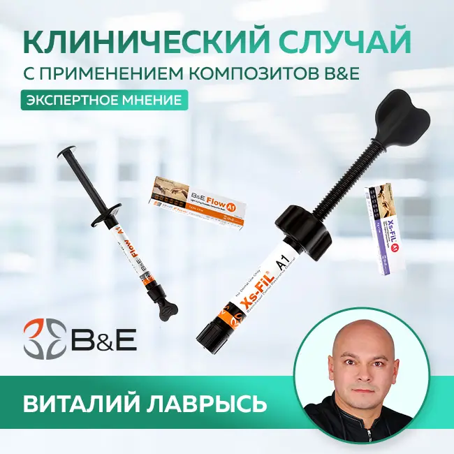 Виталий Лаврысь: "1.1 зуб, кариес дентина, класс III Black"